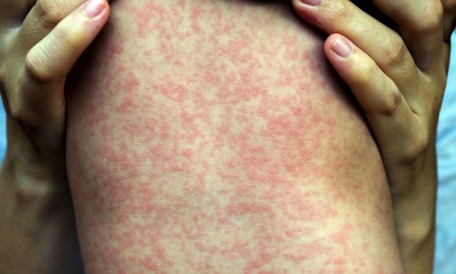 DPH Confirms Measles in Upstate Resident