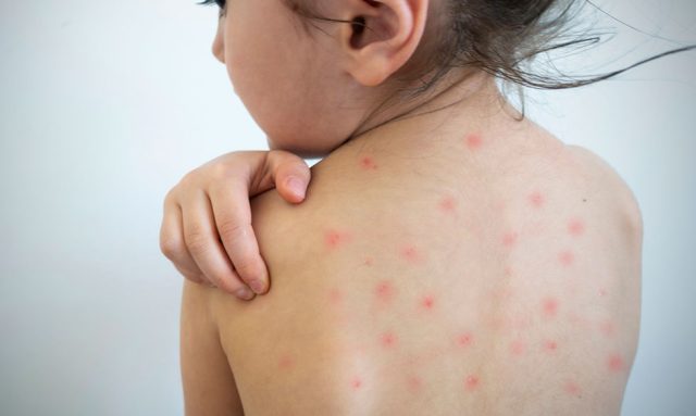DPH Reports 27 New Measles Cases in Upstate, Bringing Outbreak total to 111, Additional School Exposures