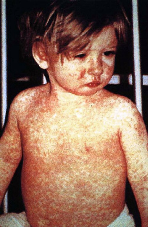 DPH Confirms Measles Outbreak in Upstate Region